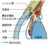 緑内障の種類 | 江口眼科病院