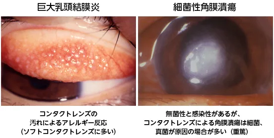 コンタクトレンズについて 江口眼科病院